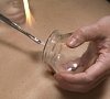 Вакуум-терапия, отдых все включено №2