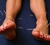 Акупунктура (рефлексотерапия, иглоукалывание), отдых все включено №10