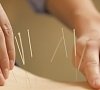 Акупунктура (рефлексотерапия, иглоукалывание), отдых все включено №3
